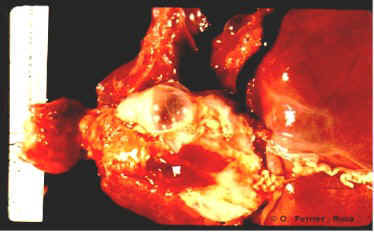 Enfisema intersticial y mediastnico